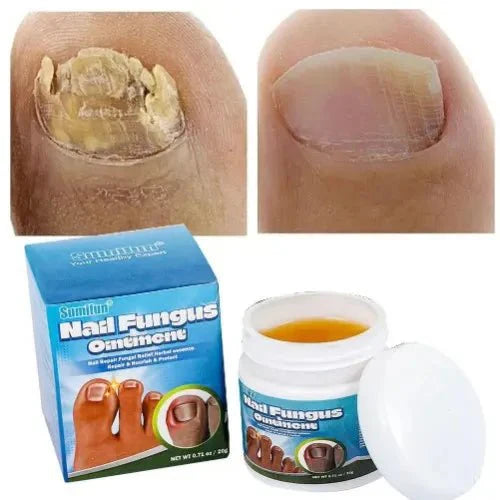 Nail Fungus Ointment