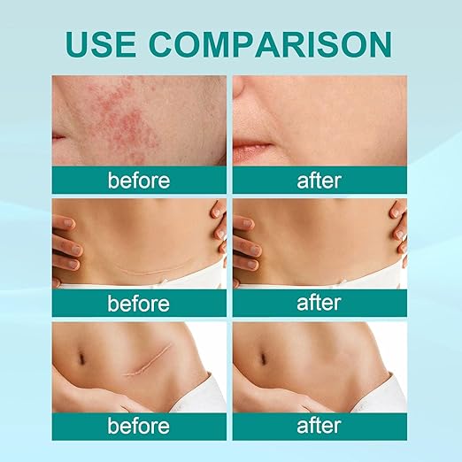 Anti Scar Spray by South Moon