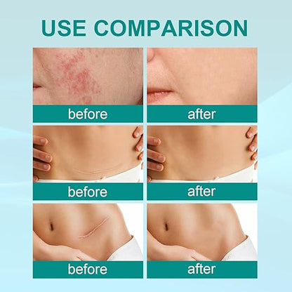 Anti Scar Spray by South Moon