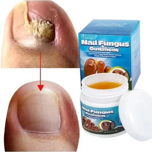 Nail Fungus Ointment